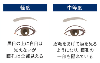軽度　黒目の上に白目は見えないが瞳孔は全部見える　中等度　眉毛をあげて物を見るようになり瞳孔の一部も隠れている